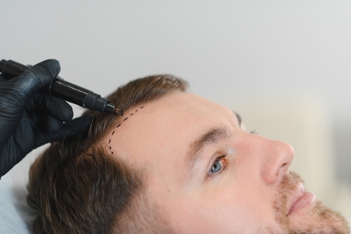 Aesthetic,Medicine.,Doctor,Trichologist,Outlines,The,Area,Of,Baldness,On